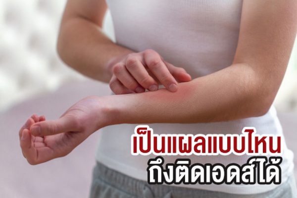 เป็นแผลแบบไหน ถึงติดเอดส์ได้